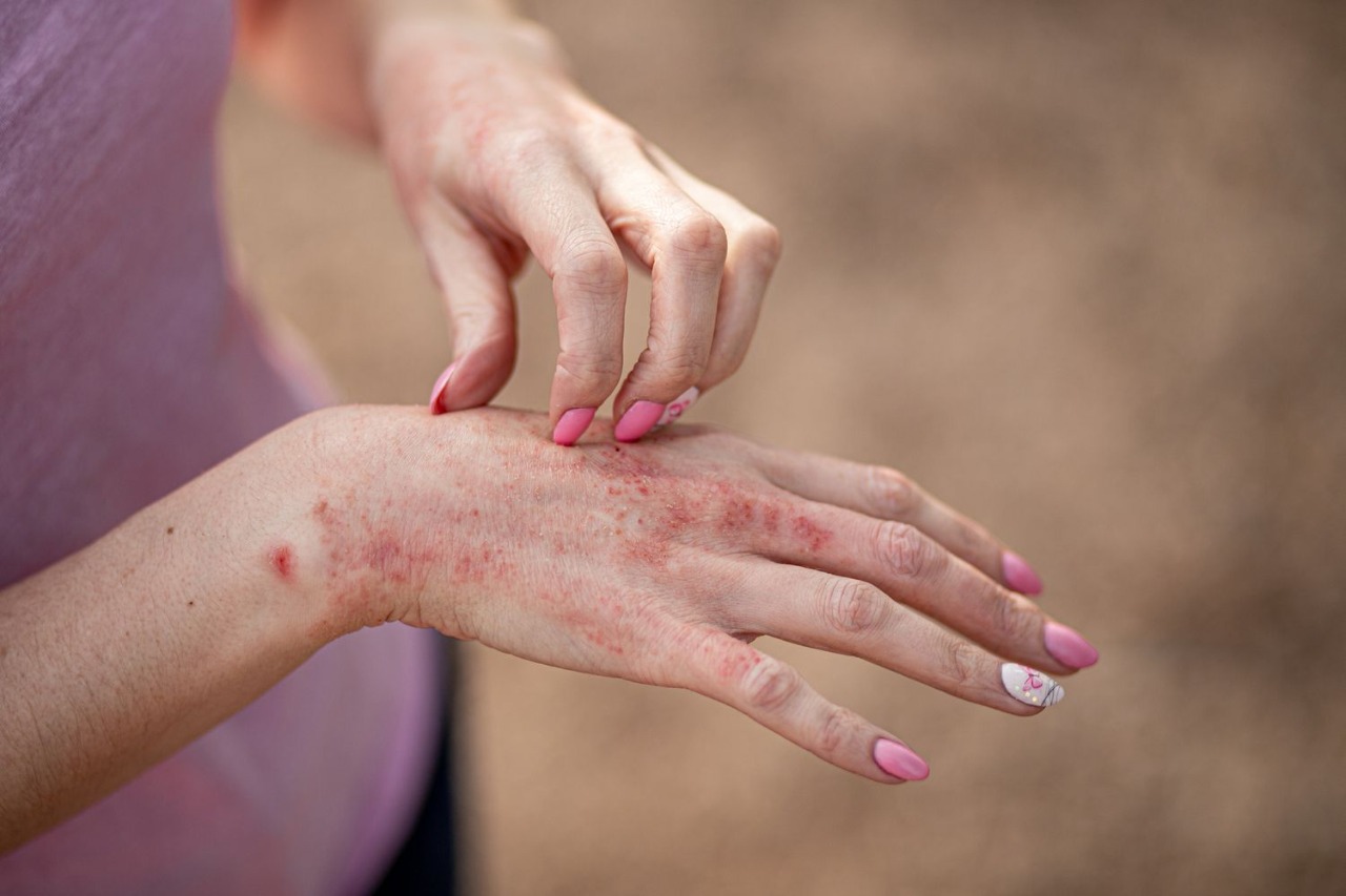 Reading the Signs: What Allergic Contact Dermatitis Looks Like